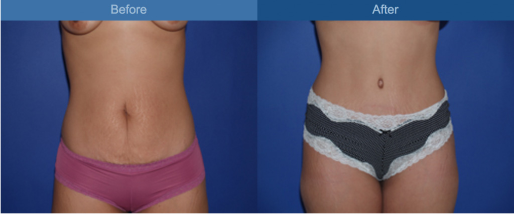 ABDOMINOPLASTY BEFORE AND AFTER