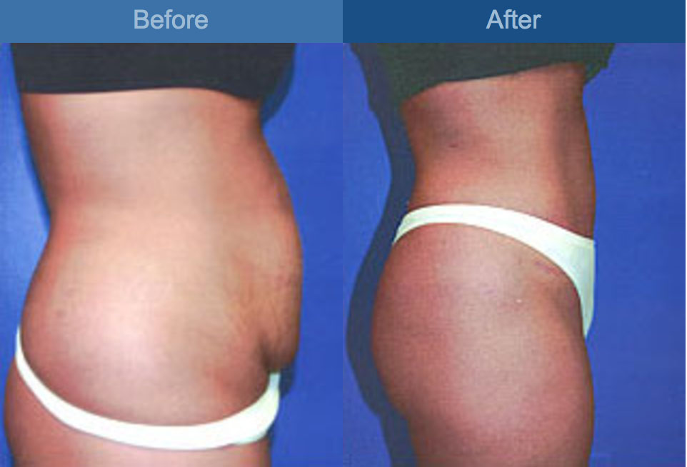 ABDOMINOPLASTY BEFORE AND AFTER