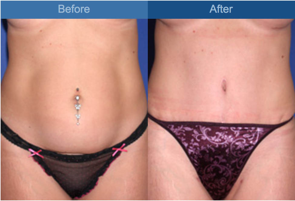 ABDOMINOPLASTY BEFORE AND AFTER
