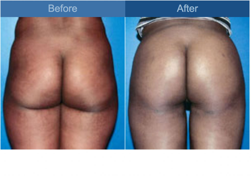 gluteal augmentation