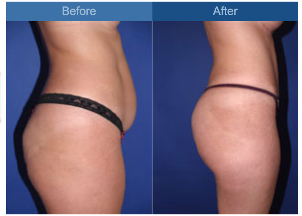gluteal augmentation procedure