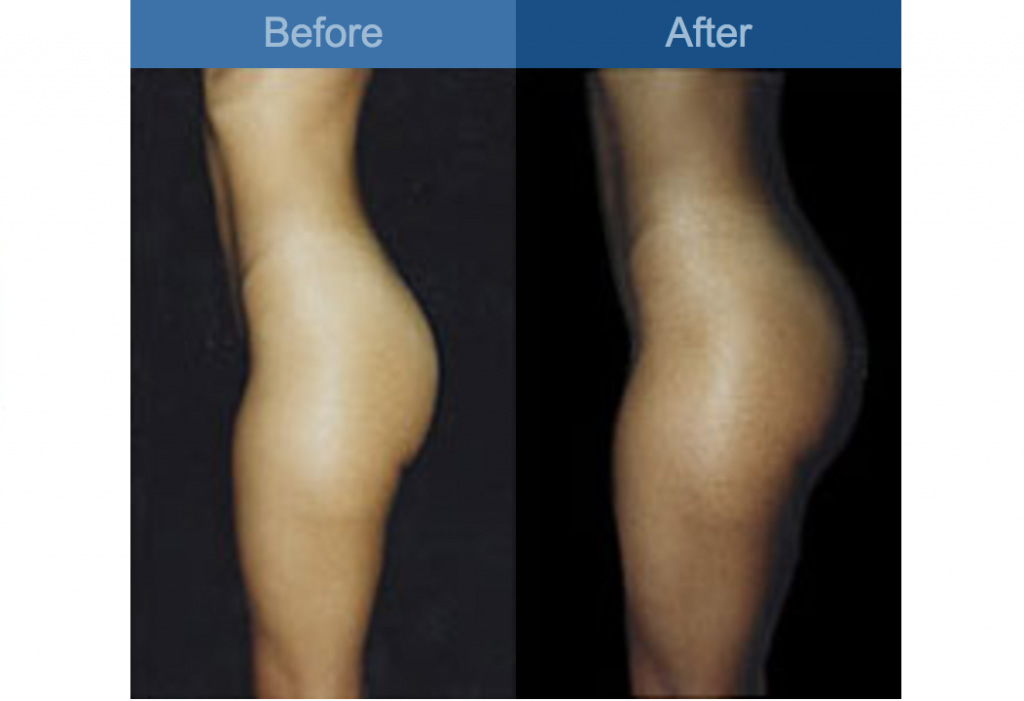 gluteal augmentation before and after