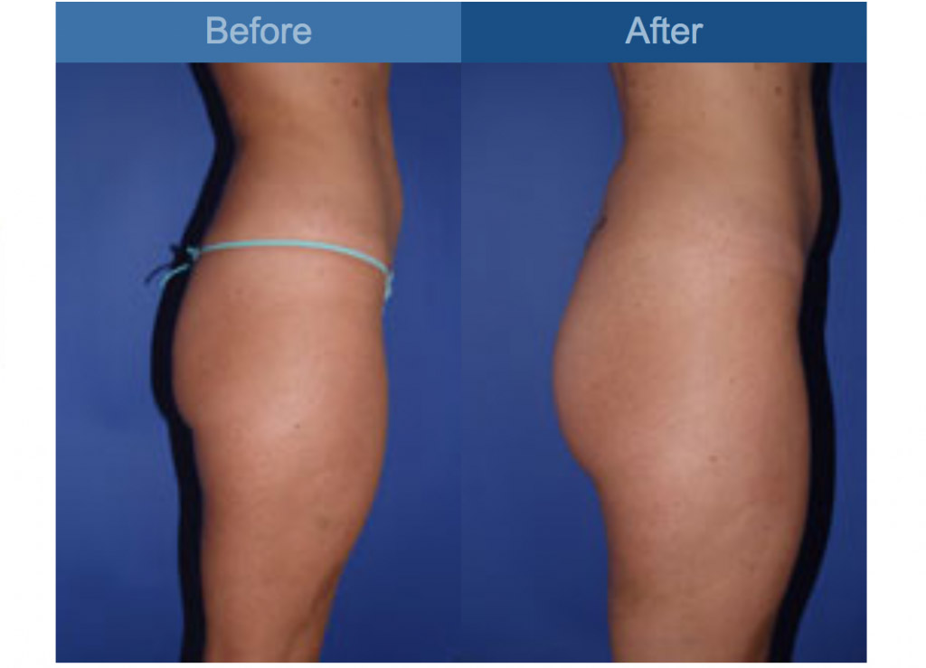 gluteal augmentation