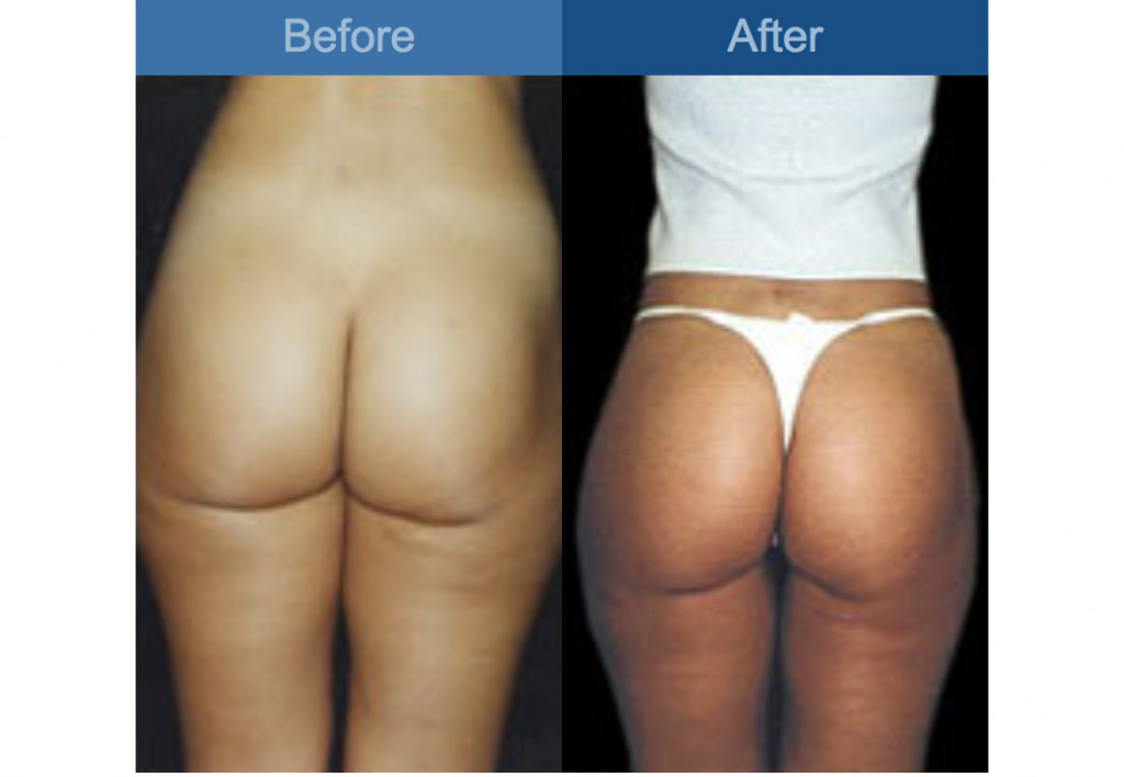 gluteal augmentation surgery