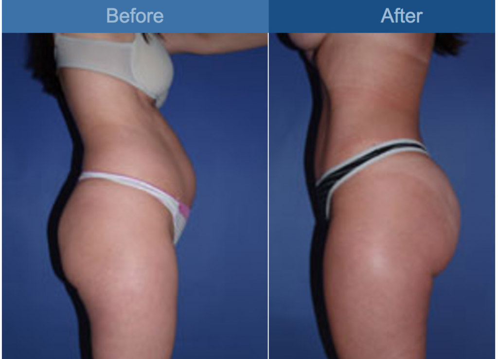Buttock Augmentation