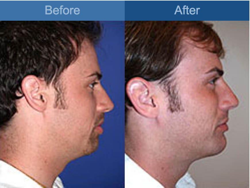 nose job before and after