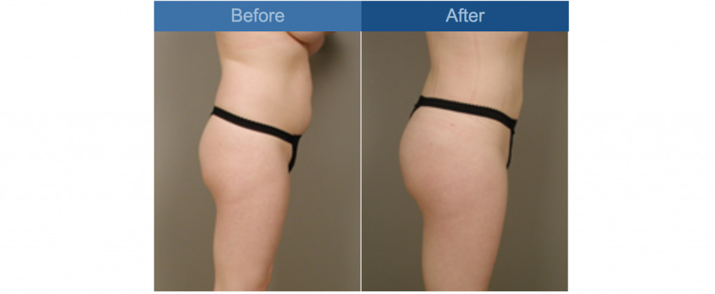 liposuction before and after