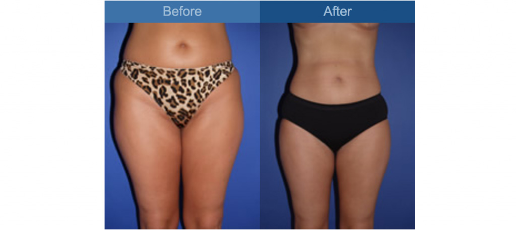 tummy tuck procedure