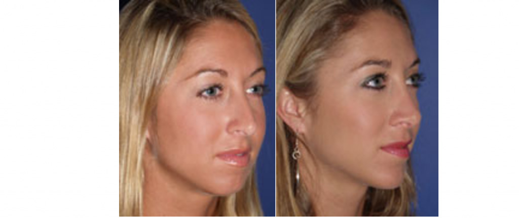 nose job