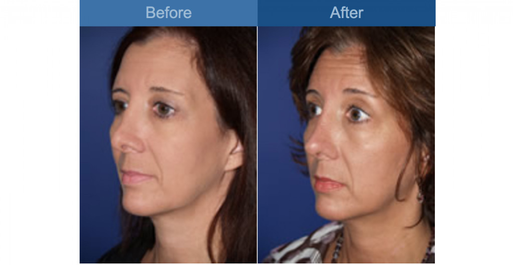 nose surgery before and after