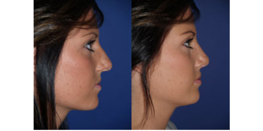 nose job before and after