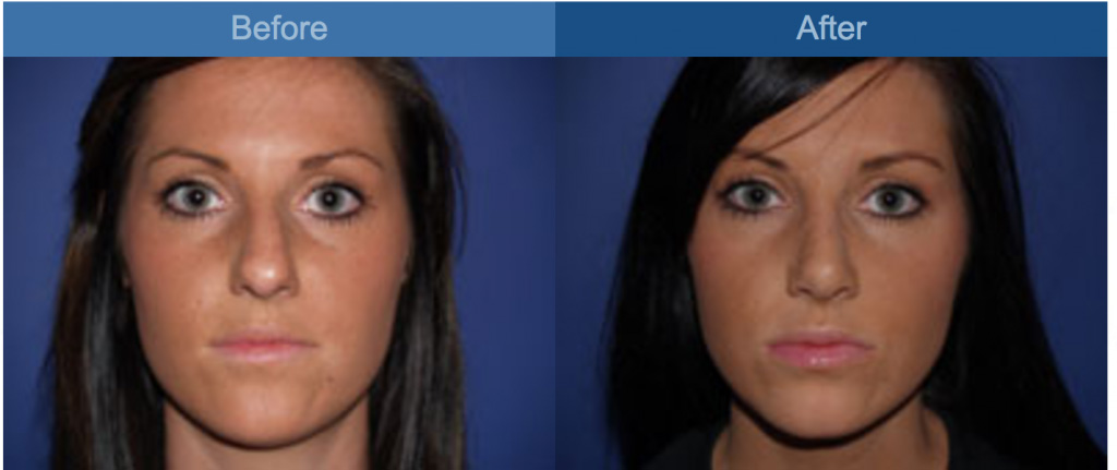 nose before and after