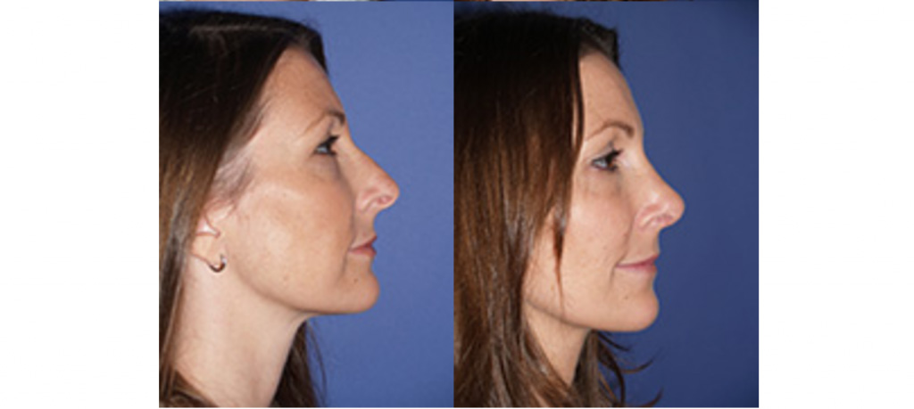 shaped nose