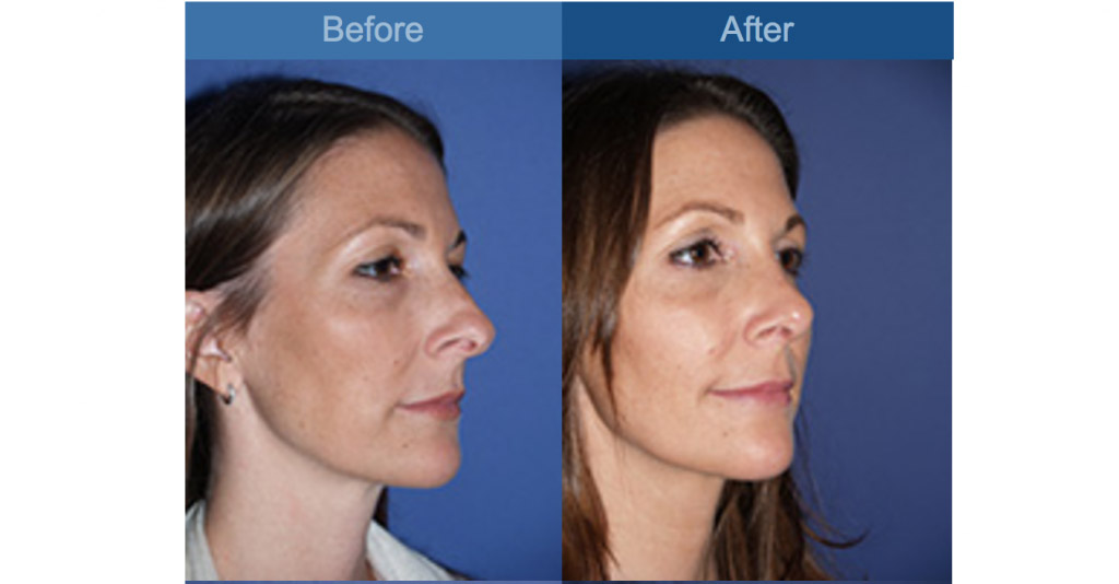 reshaped nose