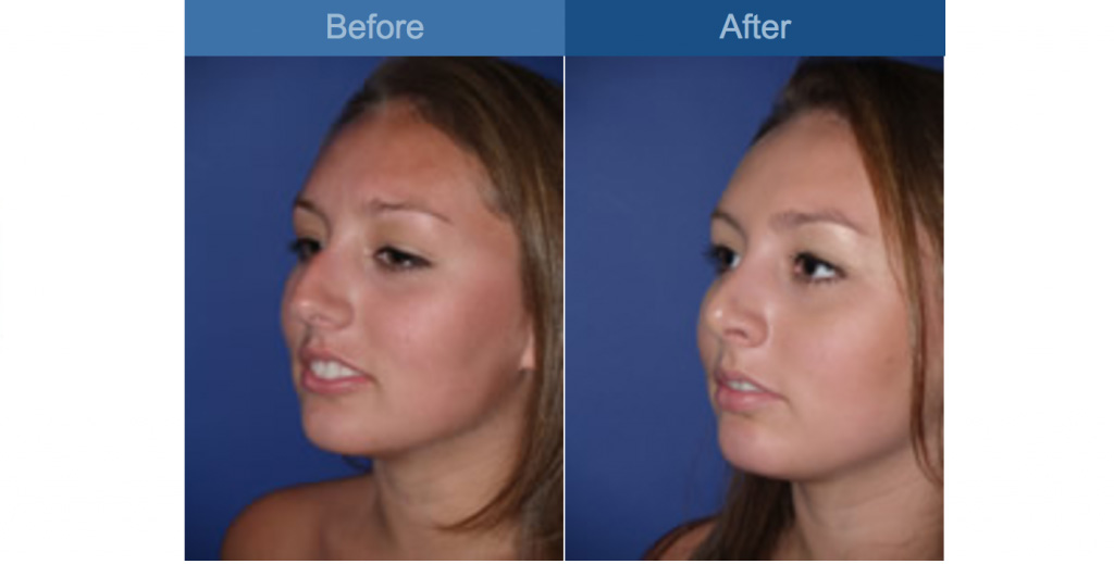 rhinoplasty procedure