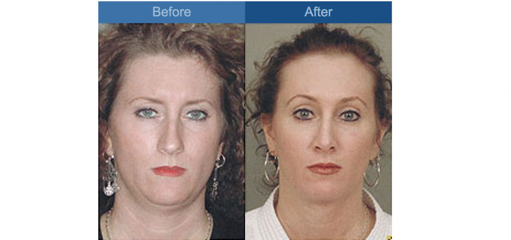 rhinoplasty surgery