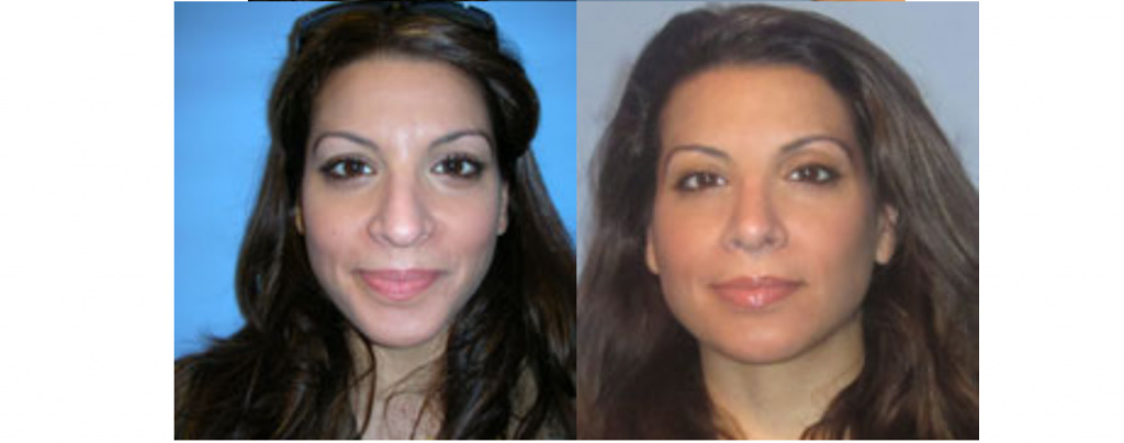 nose before and after