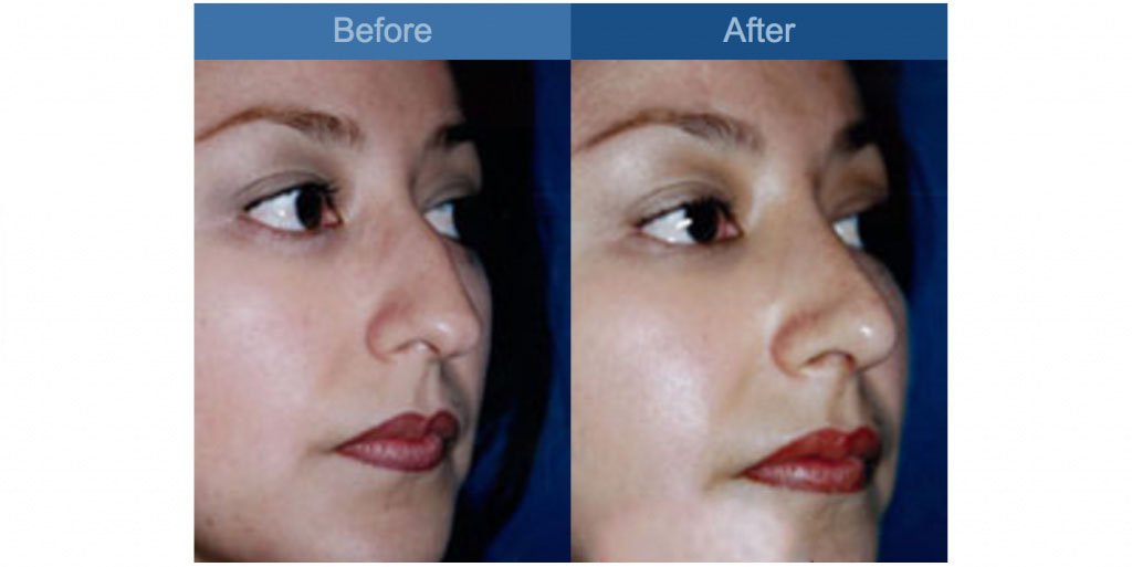 nose reshaping procedure