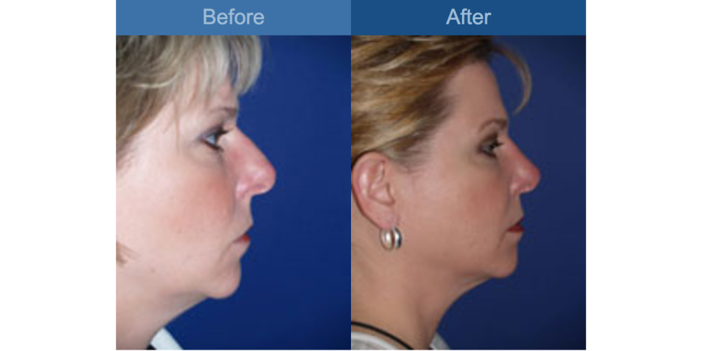 nose job