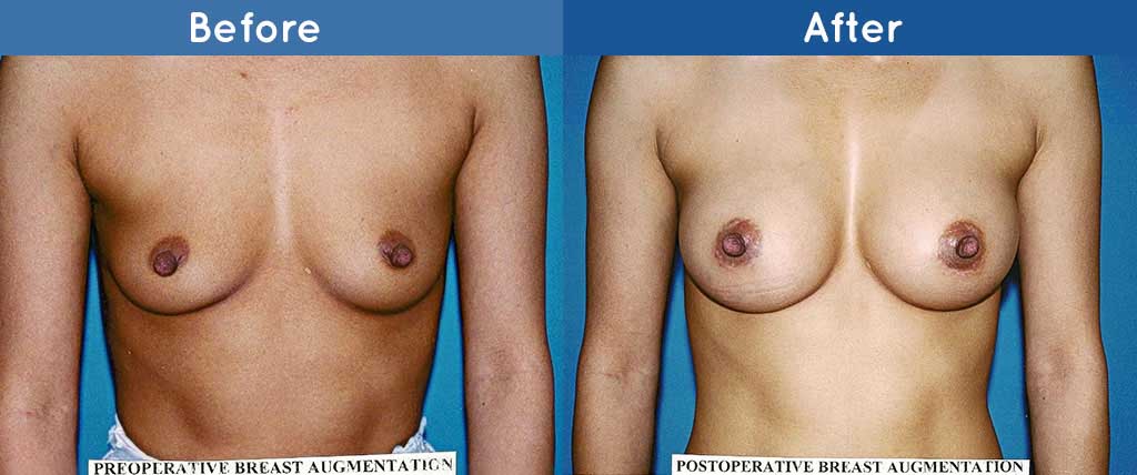 breast before and after
