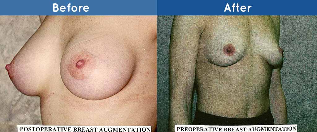 pre and post operative breast