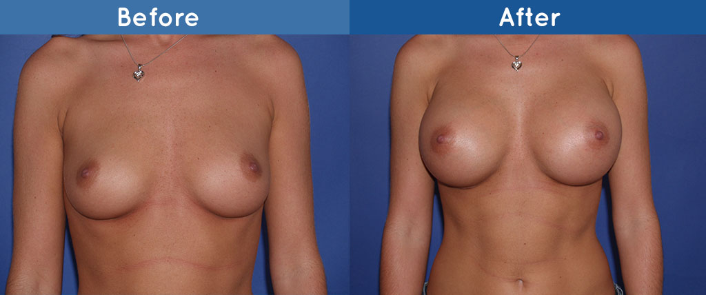breast augmentation