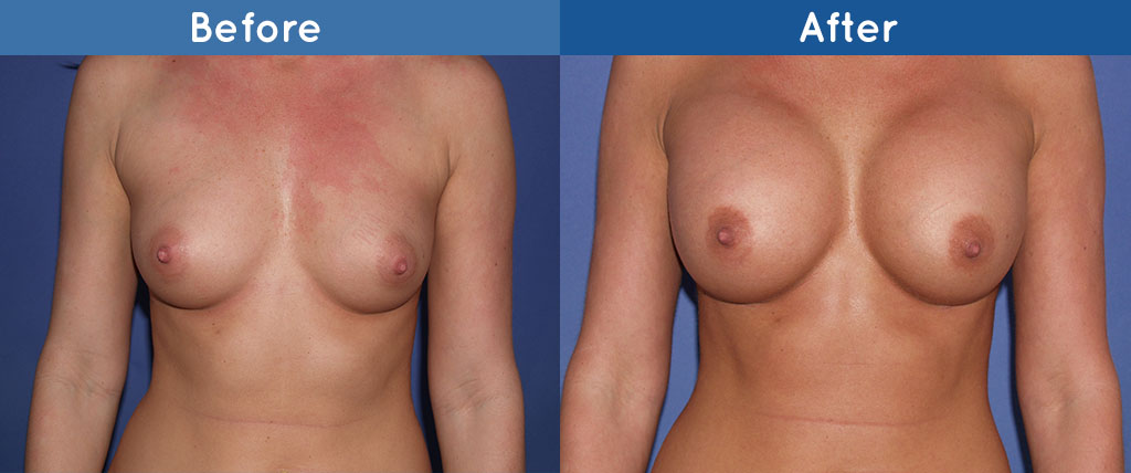 breast surgery