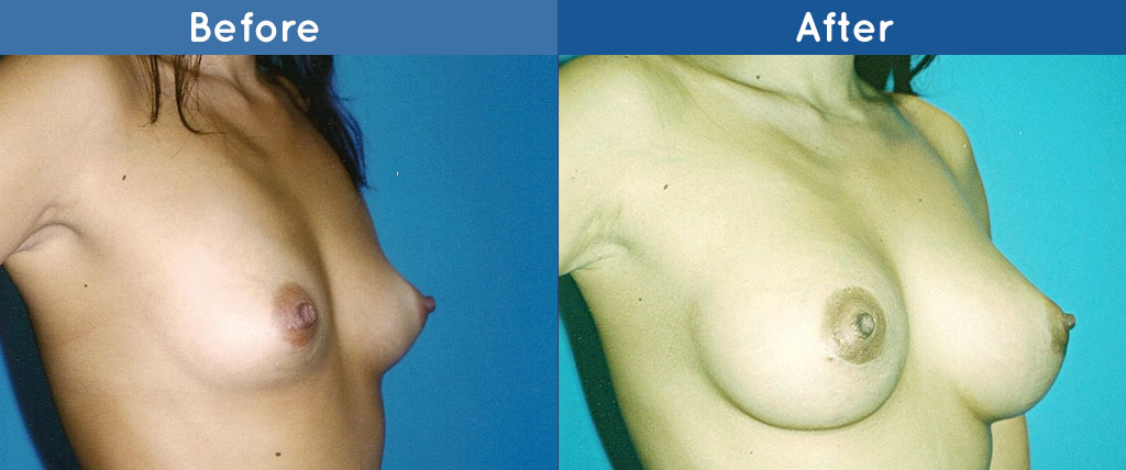 breast augmentation