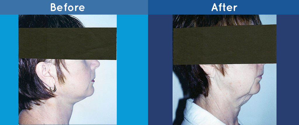 nose reshaping surgery