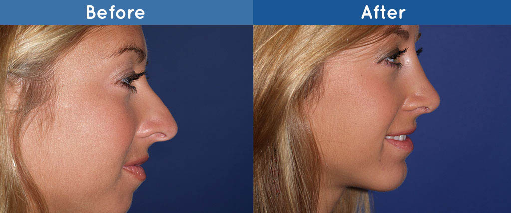 nose reshaping