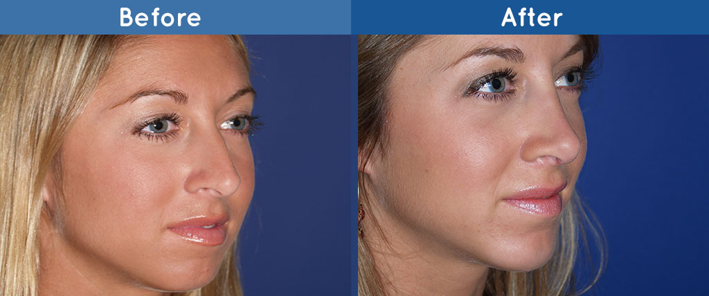 rhinoplasty before and after