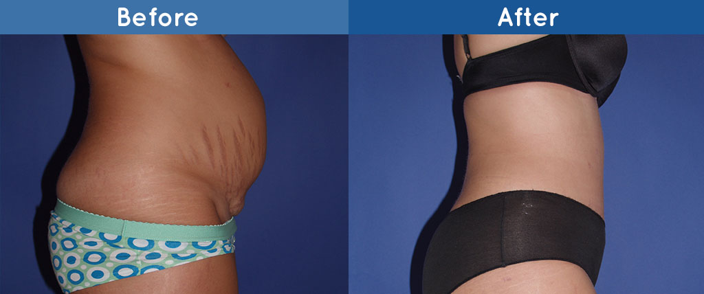 abdominoplasty side