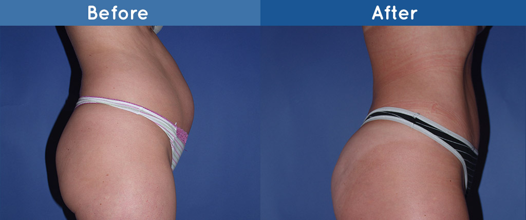 tummy tuck side