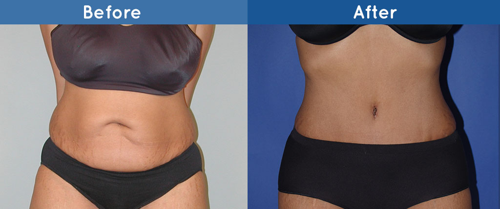 abdominoplasty