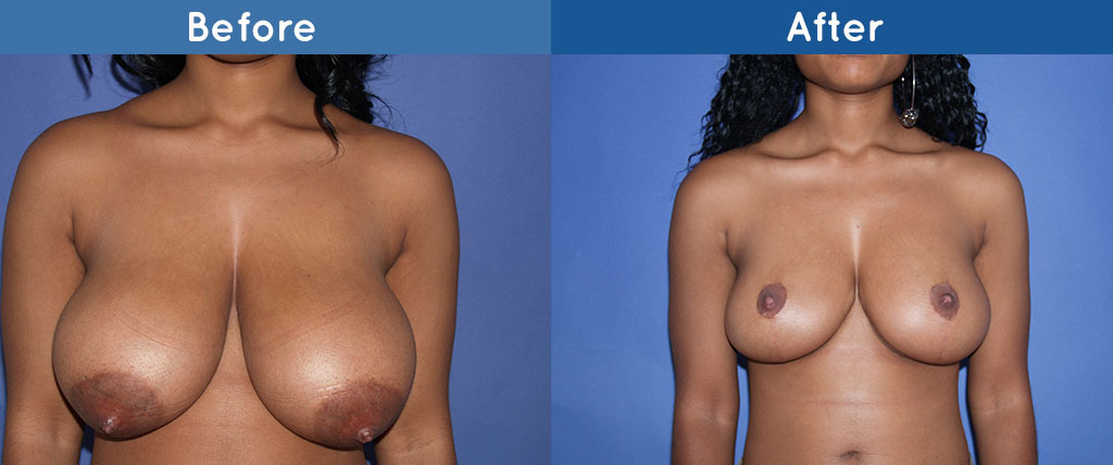 breast lift
