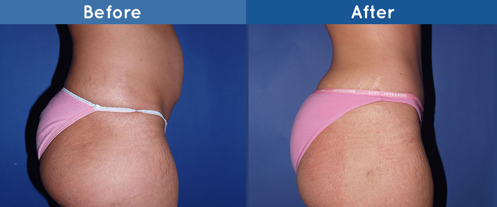 Buttock Augmentation procedure