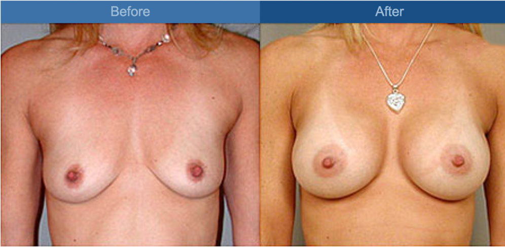 breast enlargement