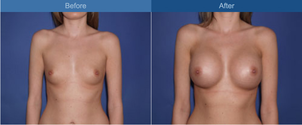 breast before and after