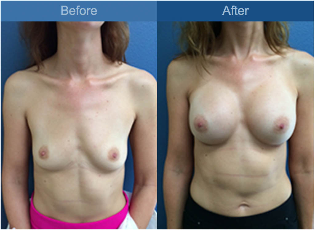 breast before and after