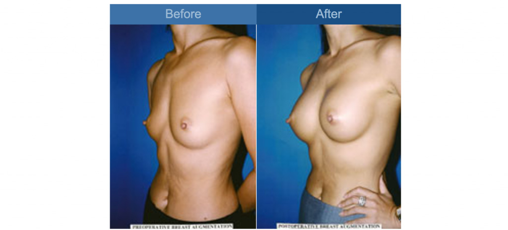 breast before and after