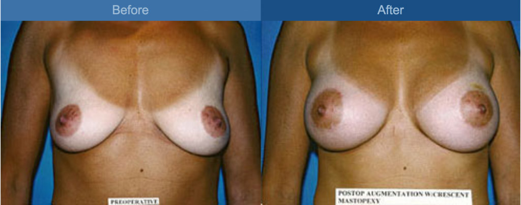 breast before and after