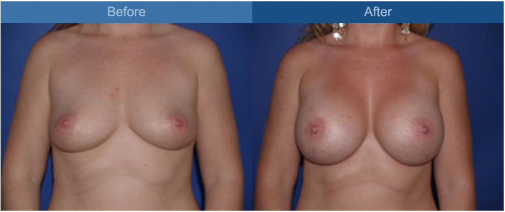 breast before and after