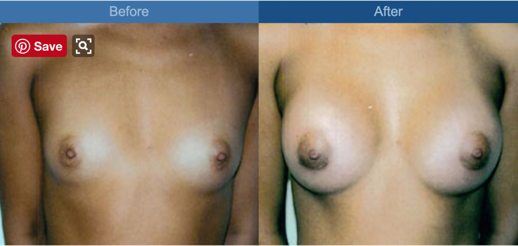 breast before and after