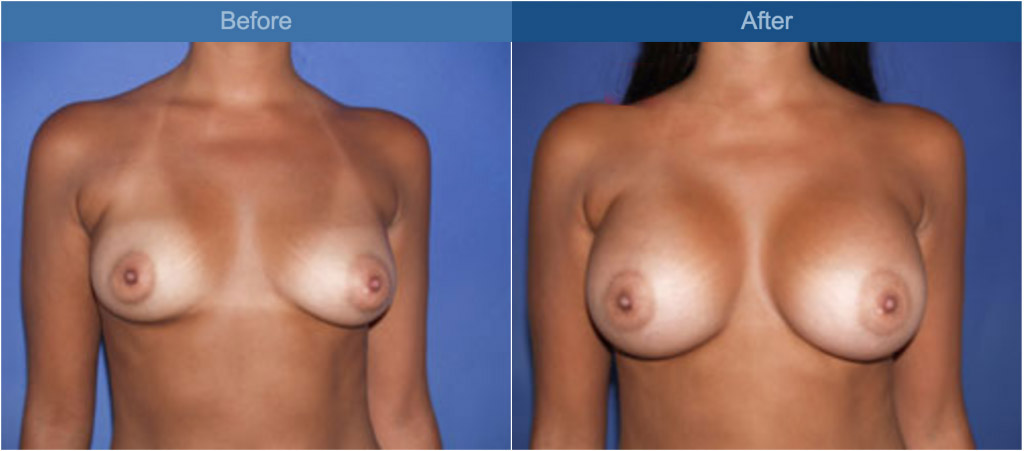 breast before and after