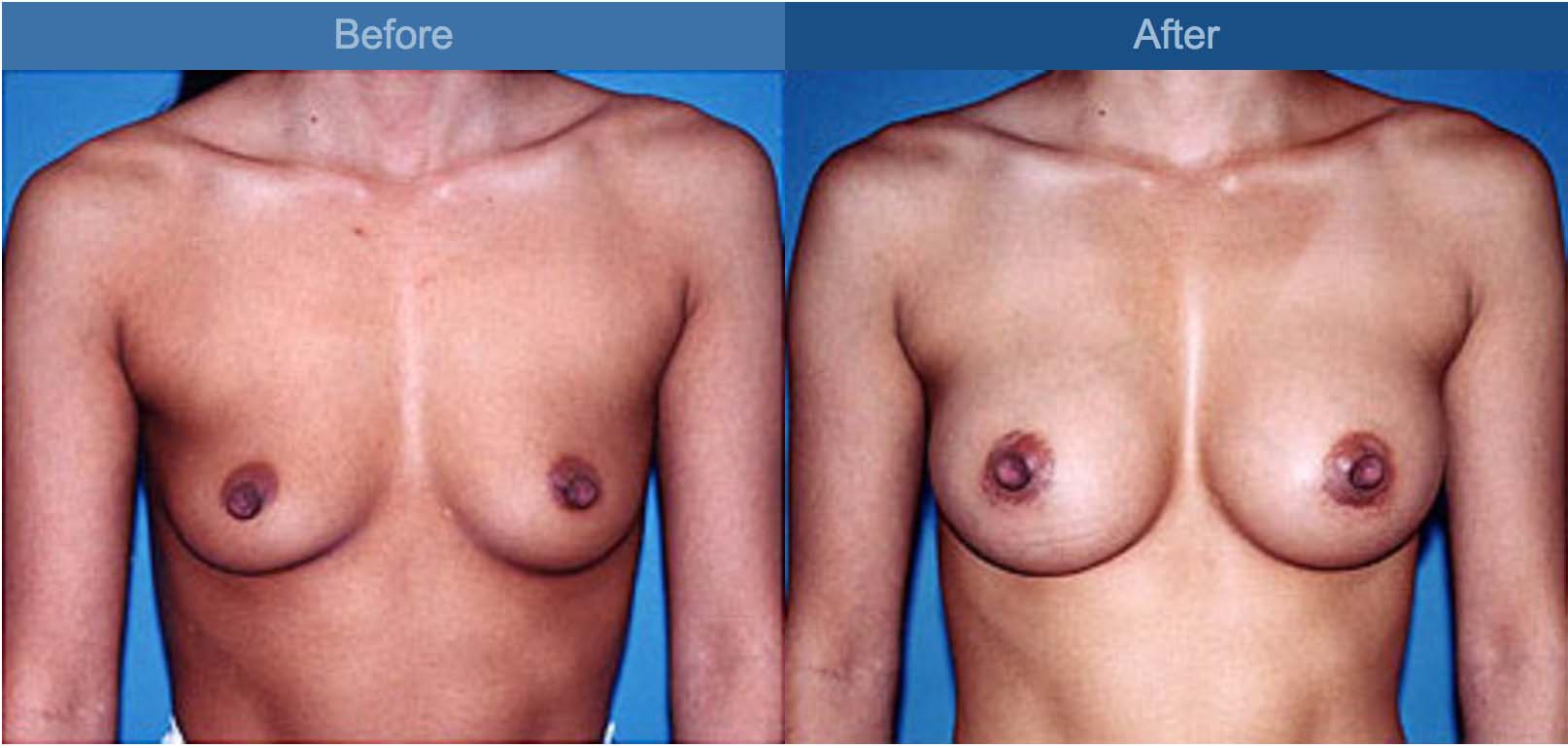 breast operation