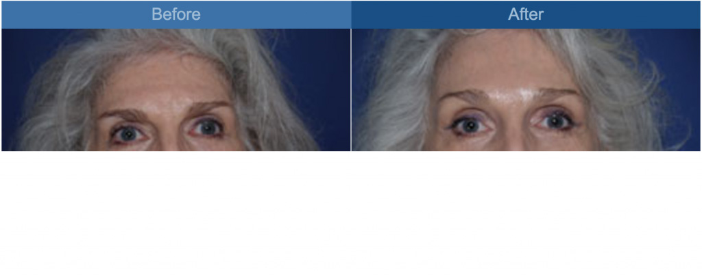 browlift before and after