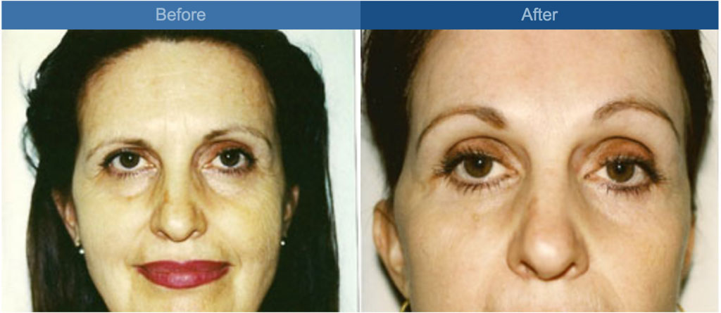 browlift procedure