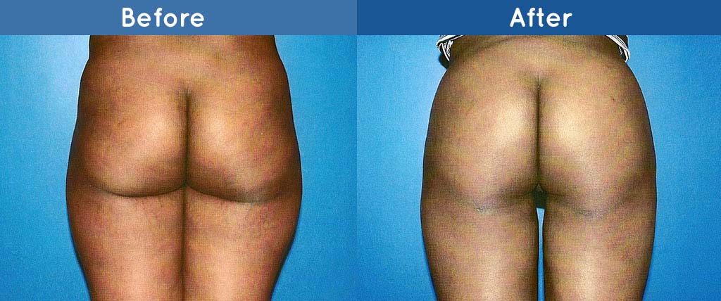 lipo surgery