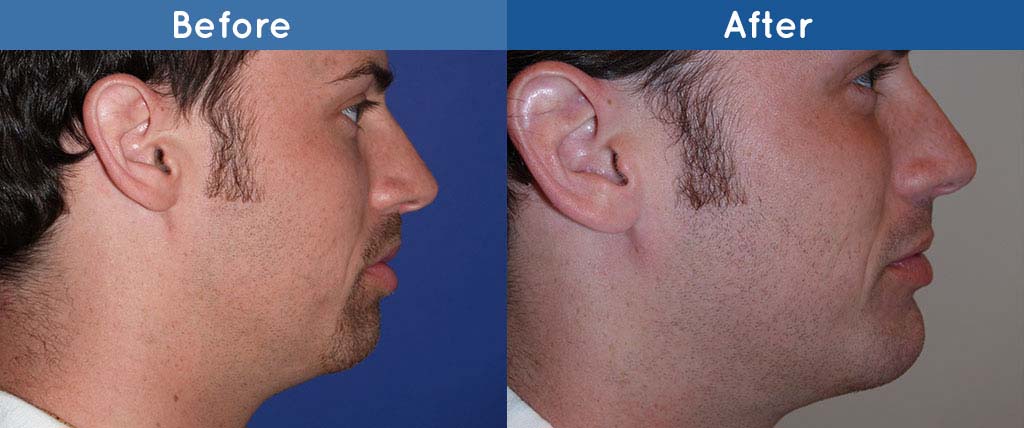 chin implant surgery