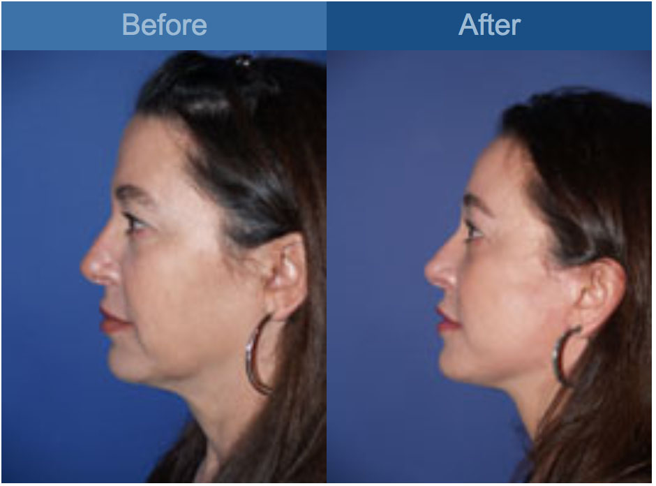 face lift
